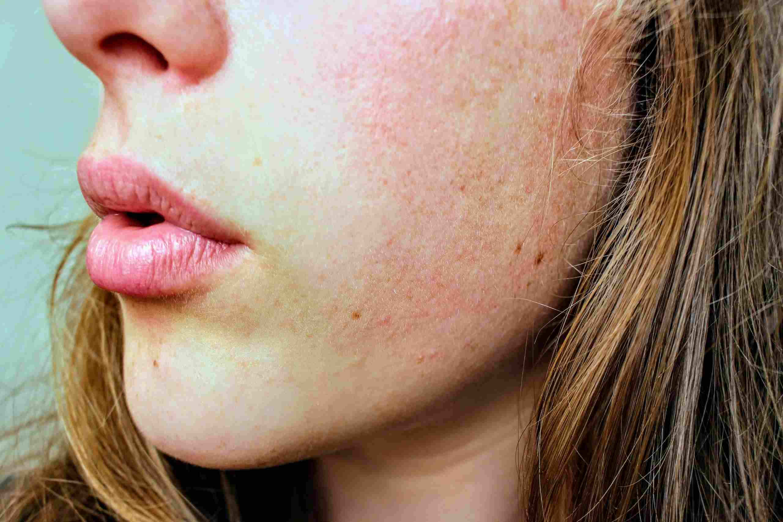 home remedies for dry skin